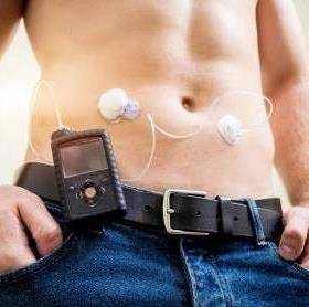 Man met diabetes draagt Medtronic insulinepomp met Enlite glucosesensor CGM