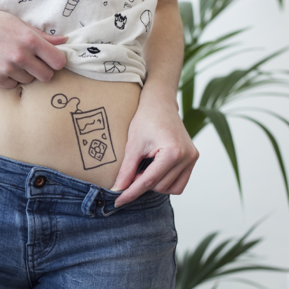 Persoon met een getekende insulinepomp op de buik